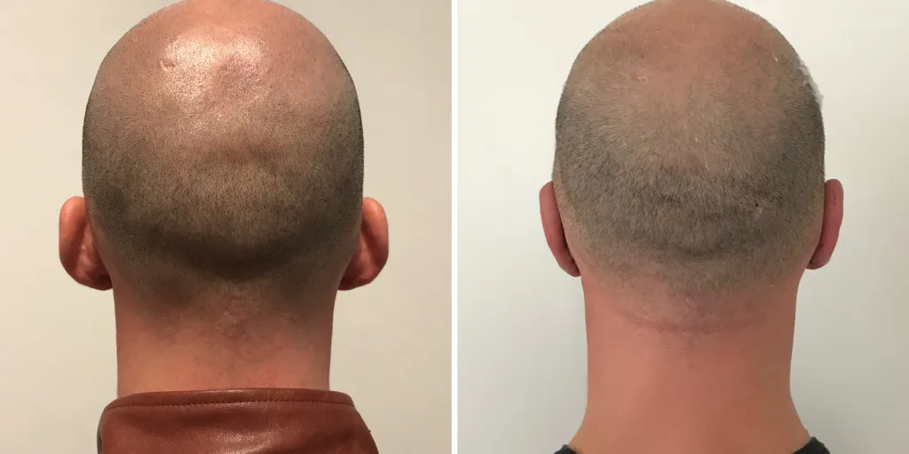 otoplastica prima e dopo
