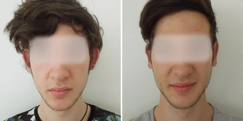 otoplastica prima e dopo