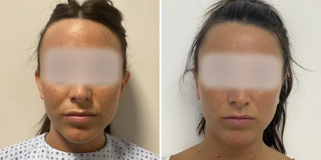 otoplastica prima e dopo
